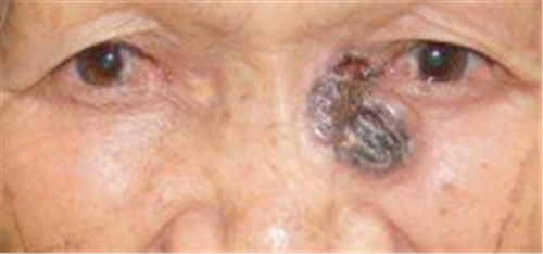 皮肤最常见的两种恶性肿瘤,一是基底细胞癌,二是鳞状父胞癌