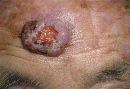 上海频道    基底细胞癌是来自皮肤基底细胞的恶性肿瘤,主要发生在